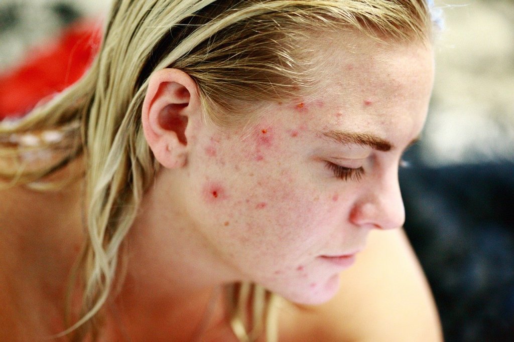 Comment les allergies et les intolérances peuvent endommager votre peau