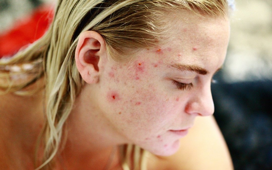 Comment les allergies et les intolérances peuvent endommager votre peau